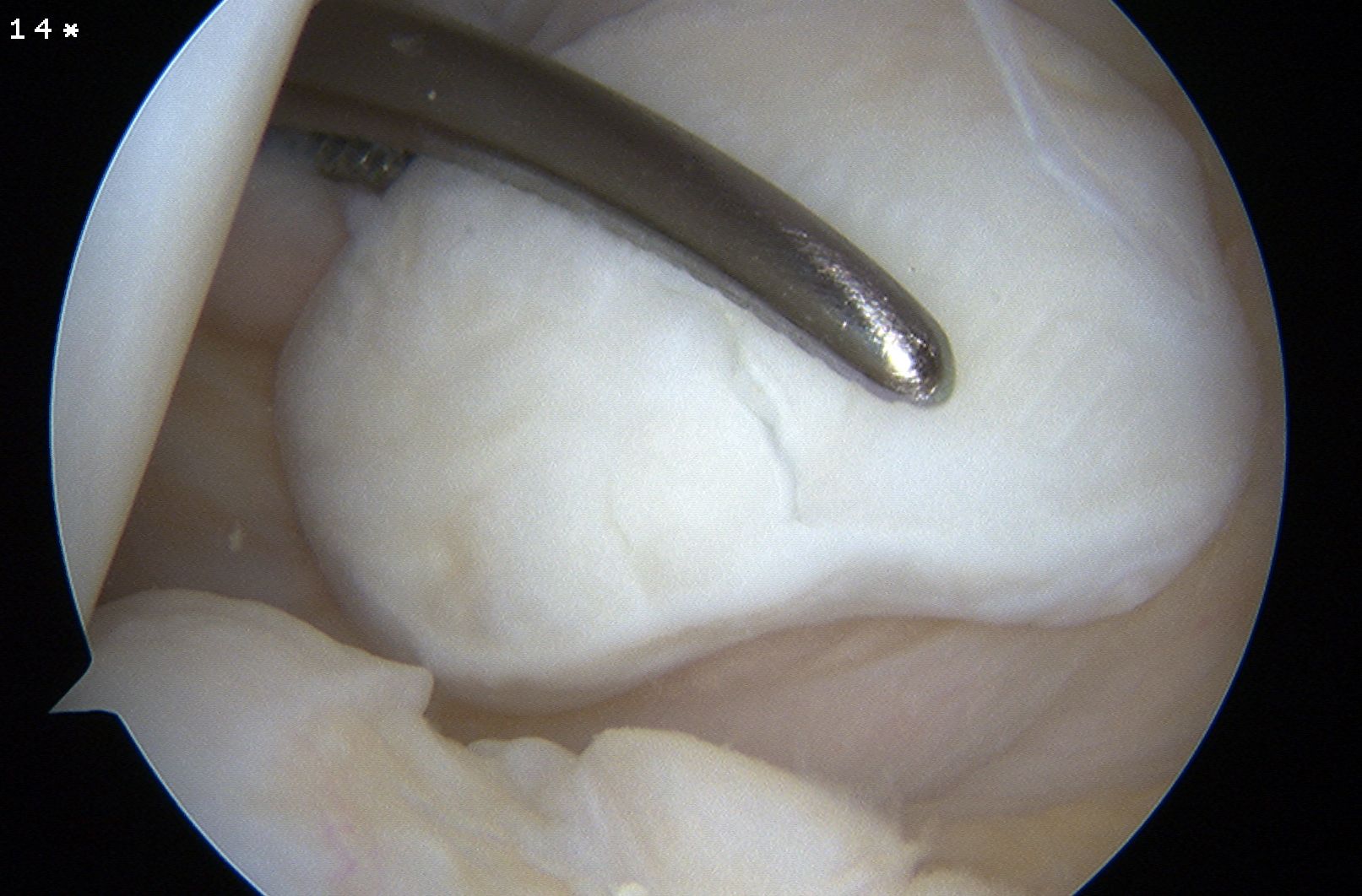 Loose Body Posteromedial Recess Retrieval